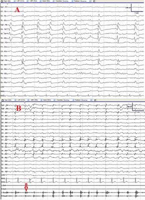 Case Report: Not All Neurological Symptoms Respond Well to Penicillin in Patients With Neurosyphilis